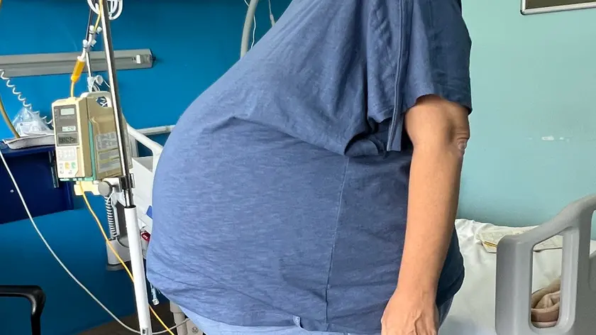 Rimosso ad Aviano un sarcoma addominale di 15 chili: la foto della paziente prima dell'intervento