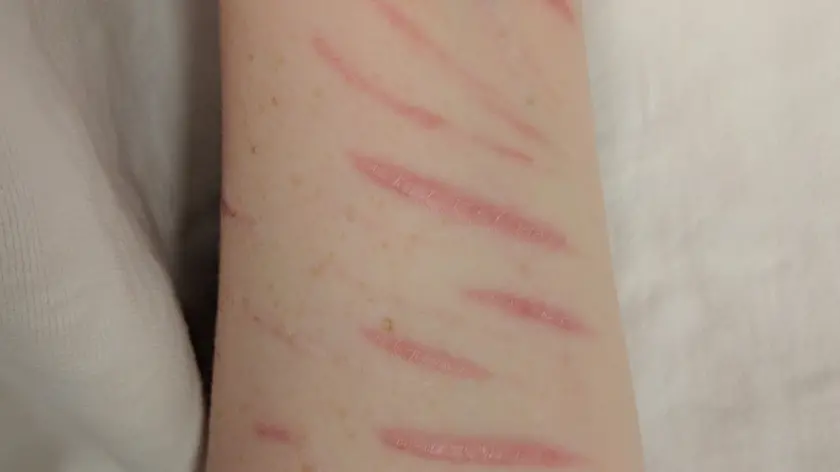 La storia di Paola, che per 4 anni si è tagliata braccia e gambe