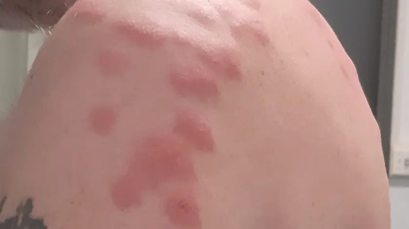 Lo sfogo sulla pelle del cliente dovuto alle cimici