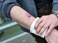 Le ferite riportate da Giovanni Galletti in seguito all'aggressione