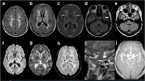 L’eterna veglia che distrugge il cervello: la speranza nasce dalla ricerca trevigiana